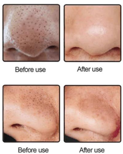 Original Blackhead Remover Pore Vacuum – Deep Pore Suction Cleanser for Face, Nose, T-Zone, Chin, Forehead, Cheeks, Ideal for Home Spa, Daily Routine, Makeup Prep, Travel, and Self-Care Gift