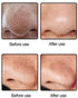 Original Blackhead Remover Pore Vacuum – Deep Pore Suction Cleanser for Face, Nose, T-Zone, Chin, Forehead, Cheeks, Ideal for Home Spa, Daily Routine, Makeup Prep, Travel, and Self-Care Gift