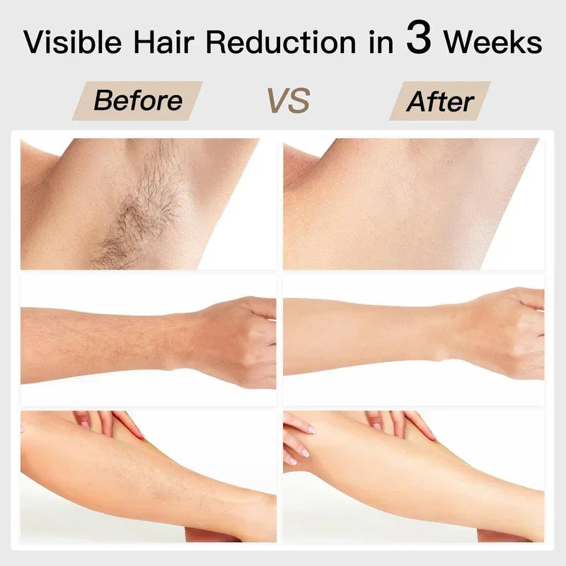 IPL Hair Removal Device – Ice‑Cooling, 20J Power, 6+1 Modes, SR Rejuvenation