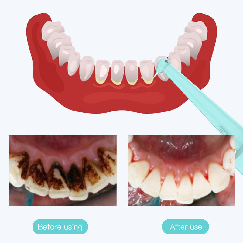 Intelligent High-Frequency Vibration Dental Calculus & Stain Remover(blue)